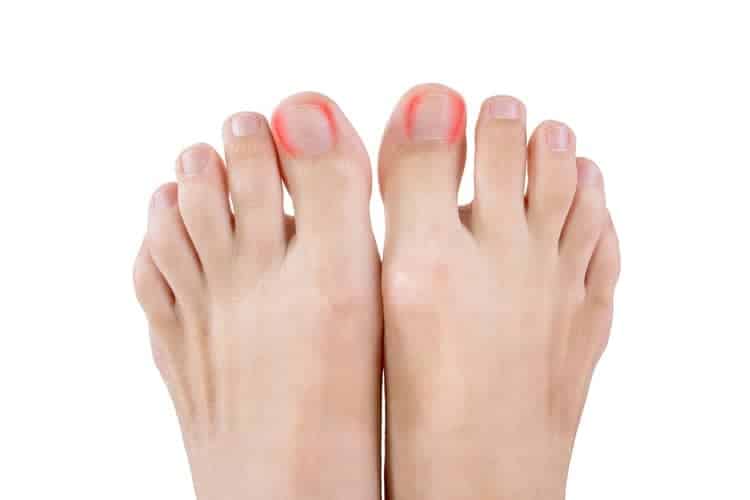 Tratamiento de las uñas encarnadas, ofrecidos por los podólogos